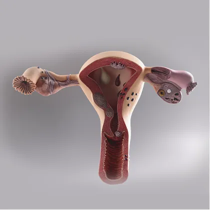 Endometriozis Nedir? Nasıl Tedavi Edilir?