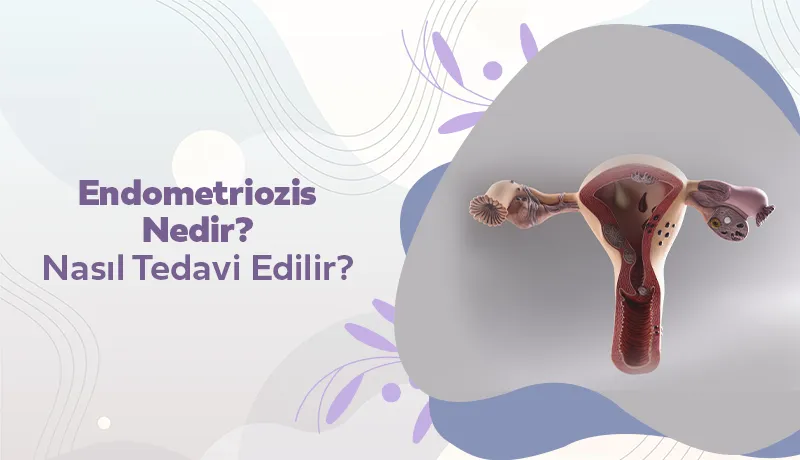 Endometriozis Nedir? Nasıl Tedavi Edilir?