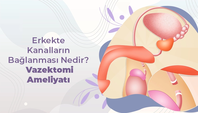 Erkekte Kanalların Bağlanması Nedir? - Vazektomi Ameliyatı