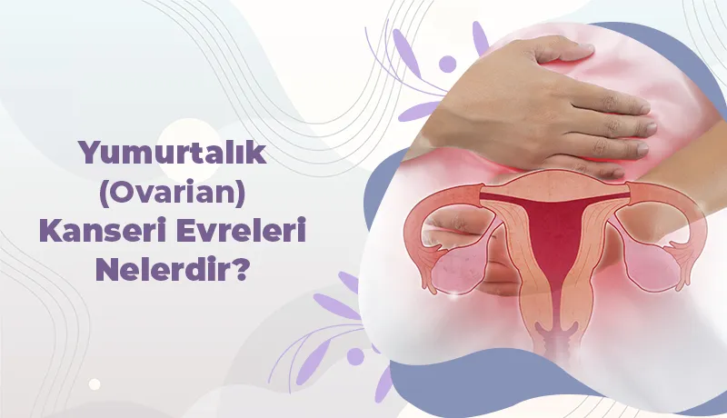 Yumurtalık (Ovarian) Kanseri Evreleri Nelerdir?